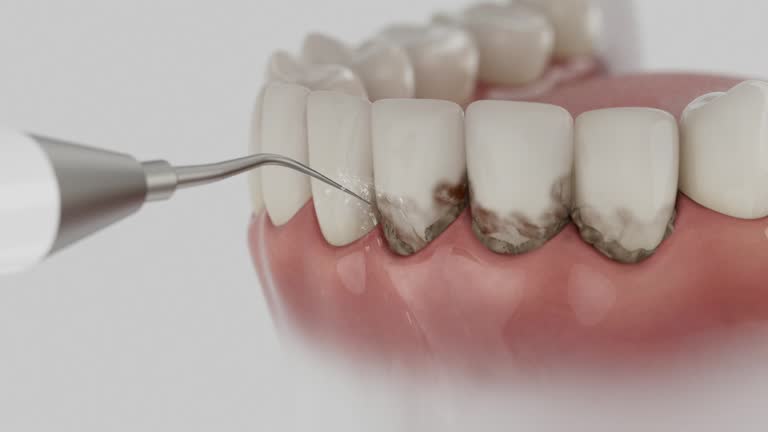 Trusted Wisdom Tooth Removal service in Aberdeen, IN - Dentist Open Now